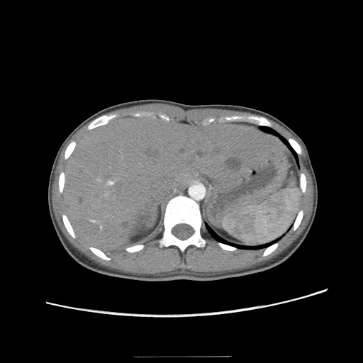 Adult polycystic kidney disease (Radiopaedia 48845-53876 Axial renal cortical phase 5).jpg