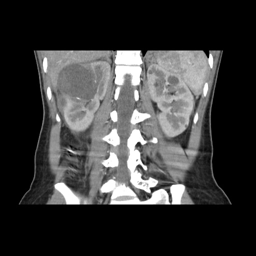 File:Adult polycystic kidney disease (Radiopaedia 48845-53876 Coronal renal cortical phase 27).jpg