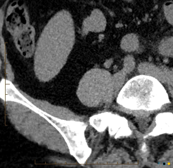 Aggressive angiomyolipoma (Radiopaedia 55765-62328 Axial non-contrast 55).jpg