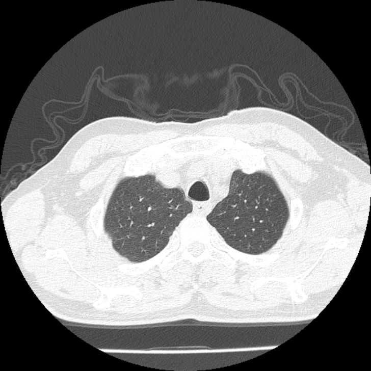 Airway foreign body in adult (Radiopaedia 85907-101779 Axial lung window 10).jpg