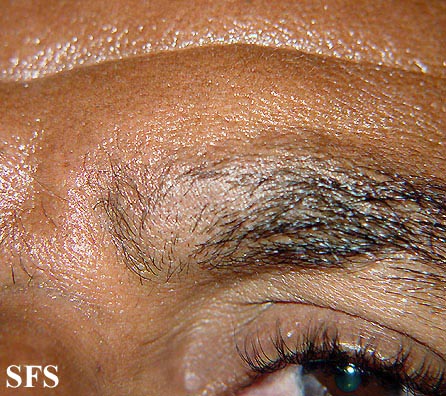 Alopecia Areata (Dermatology Atlas 16).jpg