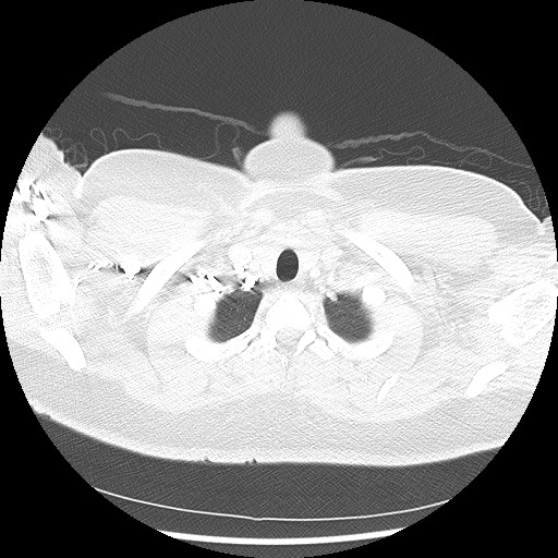 Alveolar soft part sarcoma - right leg (Radiopaedia 59432-67091 Axial lung window 11).jpg