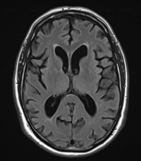 File:Alzheimer's disease- with Gerstmann syndrome and dressing apraxia (Radiopaedia 54882-61150 Axial FLAIR 15).png