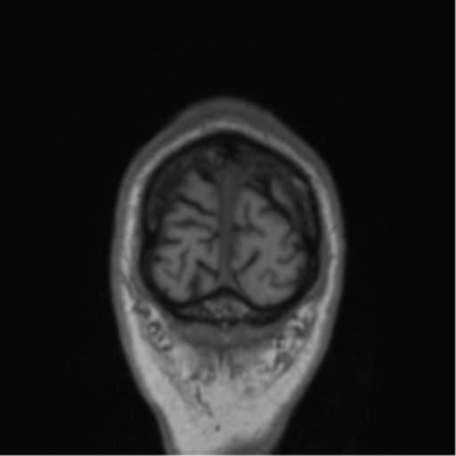 Alzheimer's disease- with Gerstmann syndrome and dressing apraxia (Radiopaedia 54882-61150 Coronal T1 5).png