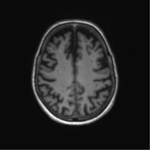 File:Alzheimer's disease (Radiopaedia 42658-45802 Axial T1 50).png