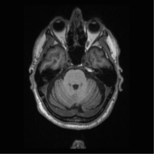 Alzheimer disease - probable (Radiopaedia 35334-36837 Axial T1 25).png