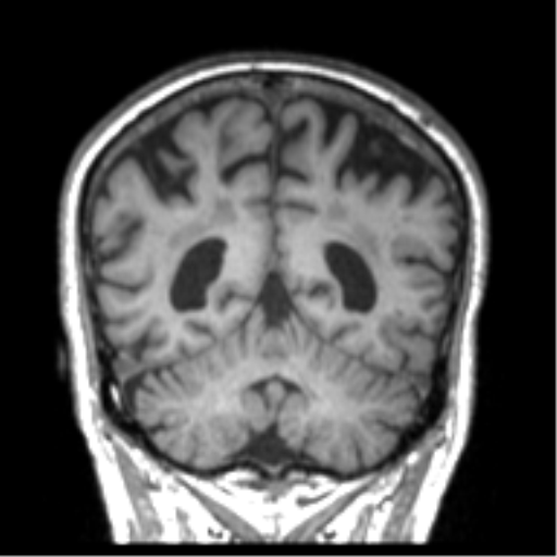 Alzheimer disease and cerebral amyloid angiopathy (Radiopaedia 64234-73011 Coronal T1 14).png