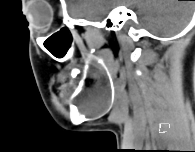 File:Ameloblastoma (Radiopaedia 26645-26793 Sagittal C+ delayed 10).jpg