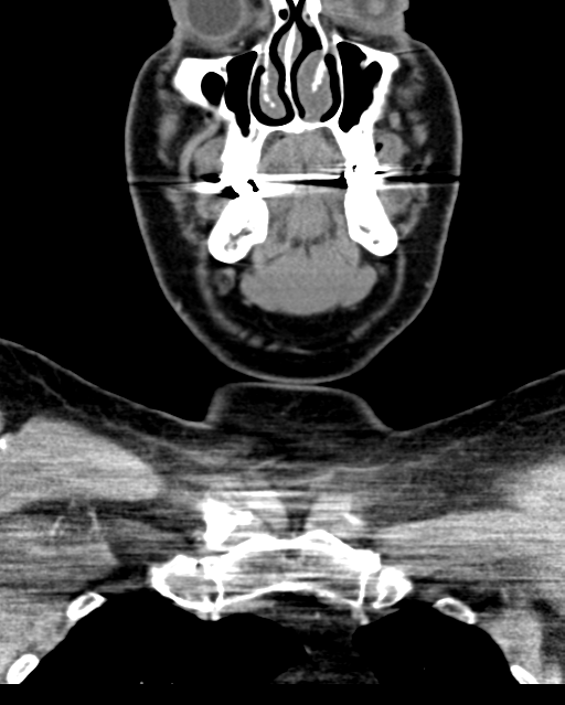 Ameloblastoma (Radiopaedia 38520-40623 Coronal non-contrast 22).png