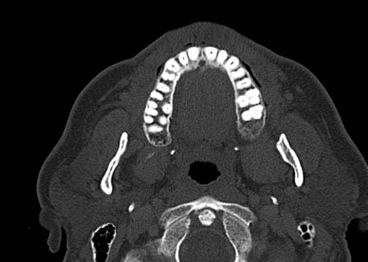 Ameloblastoma (Radiopaedia 38520-40623 D 23).png