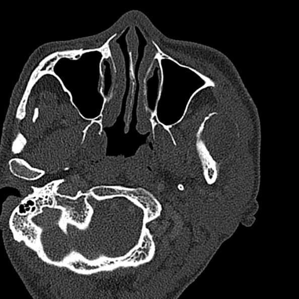 Ameloblastoma (Radiopaedia 51921-57766 Axial bone window 130).jpg