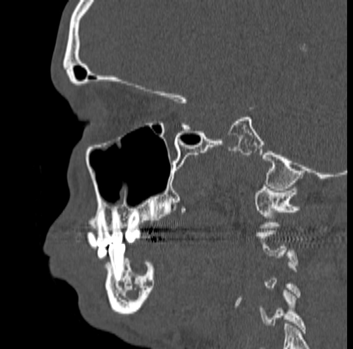Ameloblastoma (Radiopaedia 77750-89997 Sagittal bone window 28).jpg