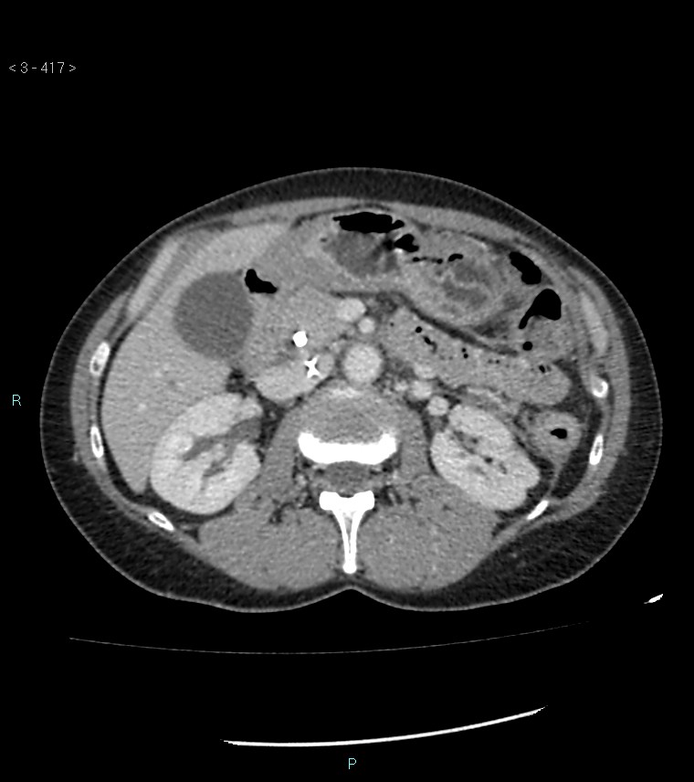 Ampulla of Vater metastasis (Radiopaedia 27820-28069 A 55).jpg