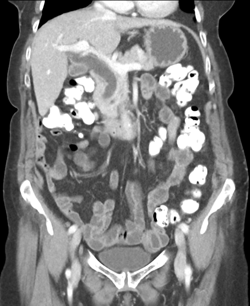 Ampullary adenocarcinoma (Radiopaedia 34013-35237 E 22).png