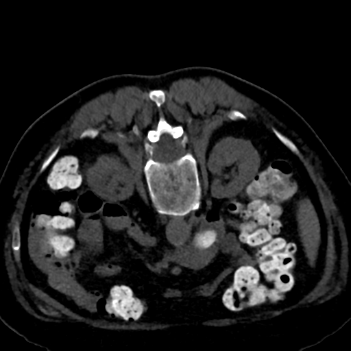 Ampullary adenocarcinoma (Radiopaedia 34013-35241 C 50).png