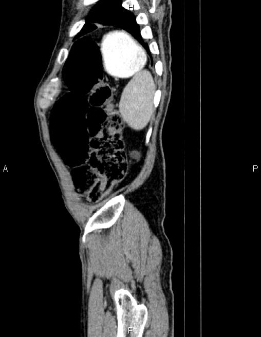 Ampullary adenocarcinoma (Radiopaedia 86093-102032 D 88).jpg