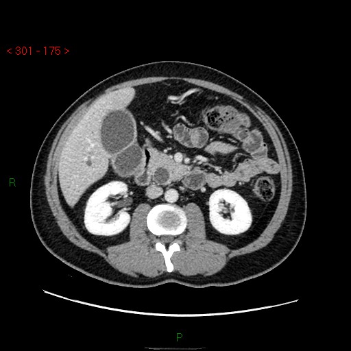 File:Ampullary carcinoma (Radiopaedia 56396-63056 C 44).jpg
