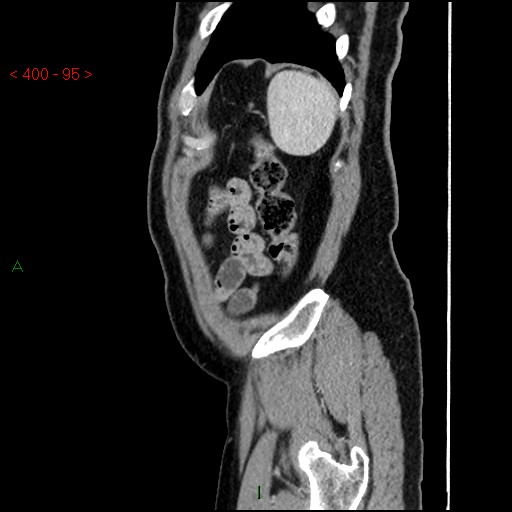 Ampullary carcinoma (Radiopaedia 56396-63056 D 94).jpg