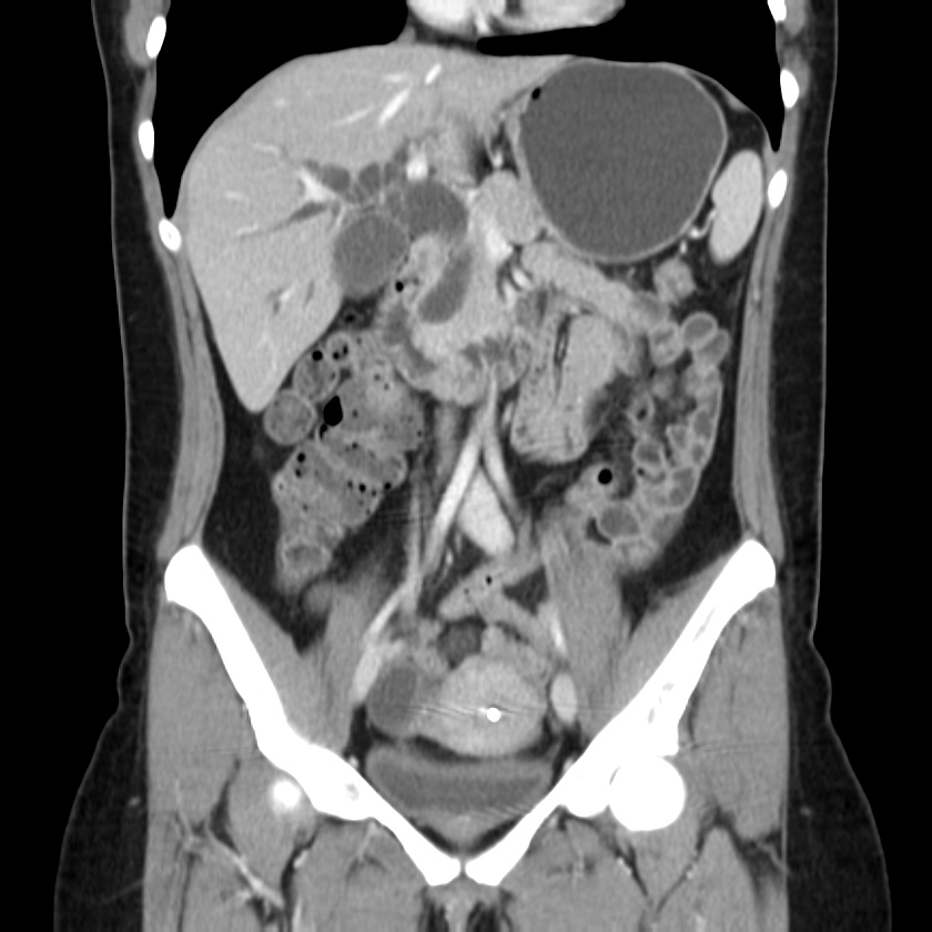Ampullary tumor (Radiopaedia 22787-22816 E 26).jpg