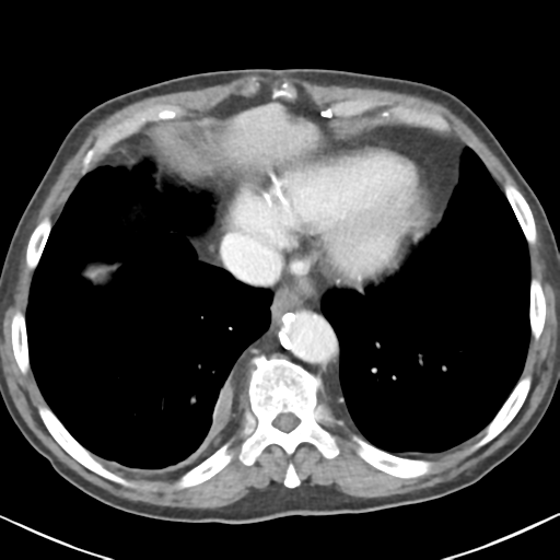 File:Amyand hernia (Radiopaedia 39300-41547 A 3).png