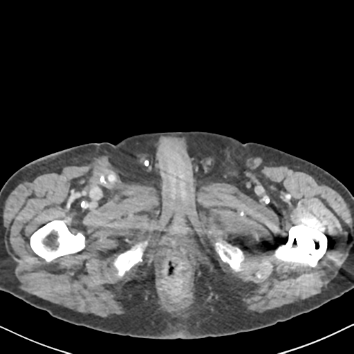 File:Amyand hernia (Radiopaedia 39300-41547 A 82).png