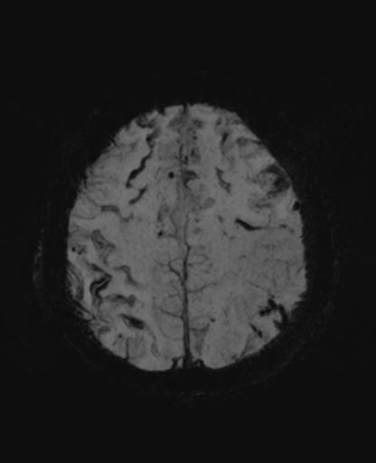 File:Amyloid angiopathy with inflammation (Radiopaedia 30360-31002 Axial SWI MIP 49).jpg