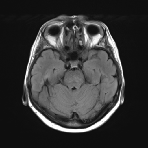 File:Anaplastic astrocytoma (Radiopaedia 86943-103160 Axial FLAIR 10).png