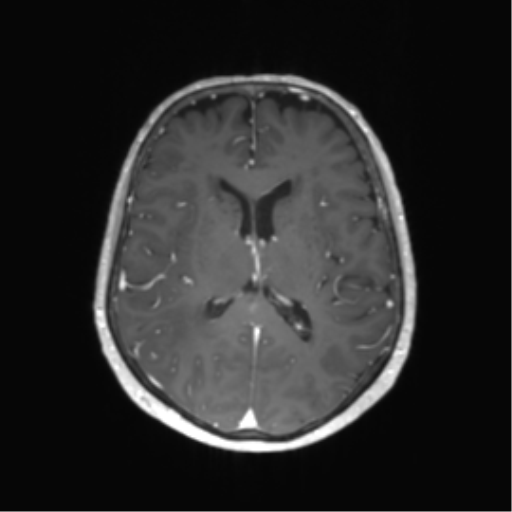 File:Anaplastic astrocytoma (Radiopaedia 86943-103160 Axial T1 C+ 36).png