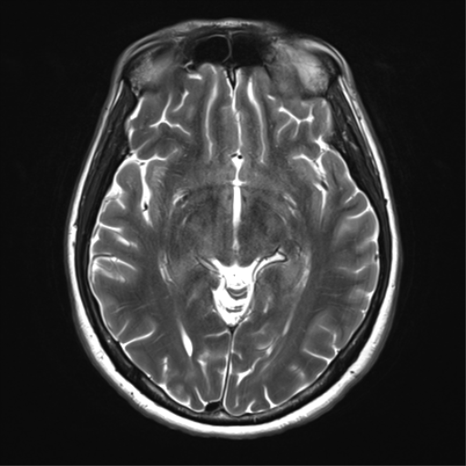File:Anaplastic astrocytoma - thalamic glioma (Radiopaedia 59709-67115 Axial T2 17).png