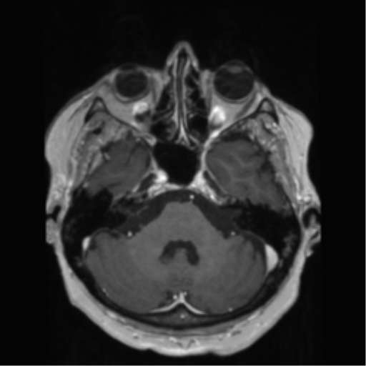 File:Anaplastic astrocytoma IDH wild-type (pseudoprogression) (Radiopaedia 42209-45278 Axial T1 C+ 49).png