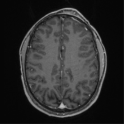 Anaplastic oligodendroglioma with skull fracture (Radiopaedia 74831-85845 Axial T1 C+ fat sat 43).png
