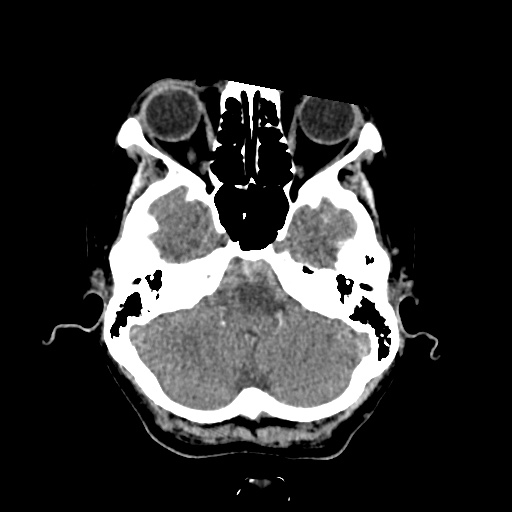 File:Aneursym related subarachnoid hemorrhage with hydrocephalus (Radiopaedia 45105-49083 Axial non-contrast 7).jpg