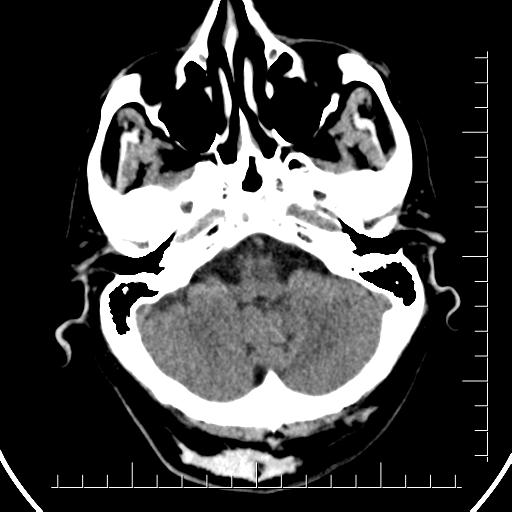 Aneurysm of posterior communicating artery (Radiopaedia 20188-20162 Axial non-contrast 9).jpg
