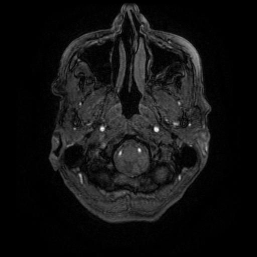 Aneurysm of the terminal internal carotid artery (Radiopaedia 88167-104764 H 10).jpg