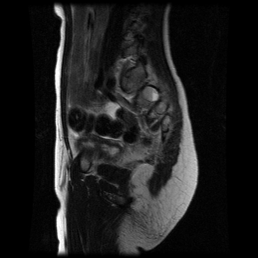 File:Aneurysmal bone cyst - sacrum (Radiopaedia 65190-74196 Sagittal T2 22).jpg