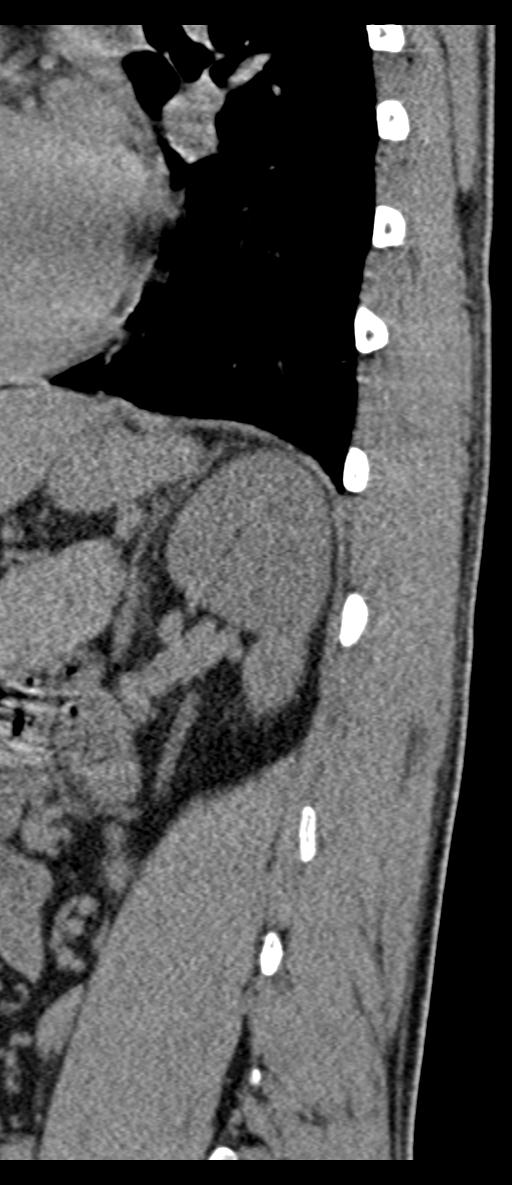 Aneurysmal bone cyst T11 (Radiopaedia 29294-29721 E 12).jpg