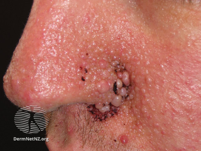 File:Angiofibromas in tuberous sclerosis (DermNet NZ systemic-angiofibromas-13).jpg