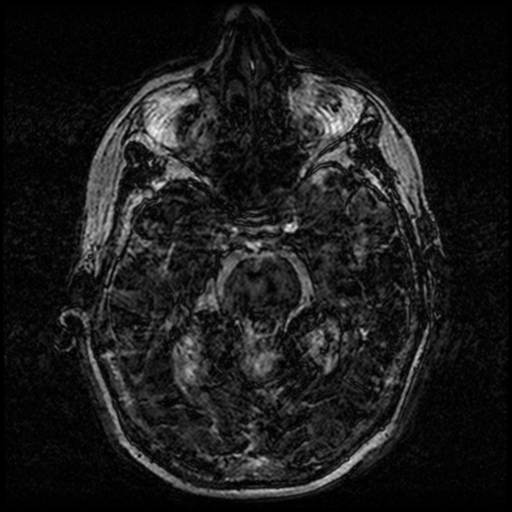 Angioinvasive aspergillosis in the pituitary fossa (Radiopaedia 39676-42010 Ax 3D FIESTA VOLUME 39).png