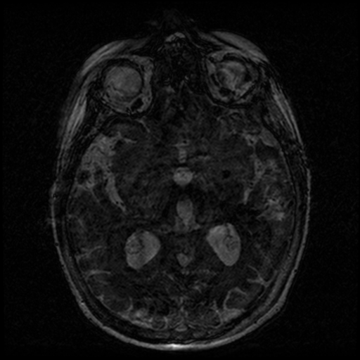 Angioinvasive aspergillosis in the pituitary fossa (Radiopaedia 39676-42010 Ax 3D FIESTA VOLUME 97).png