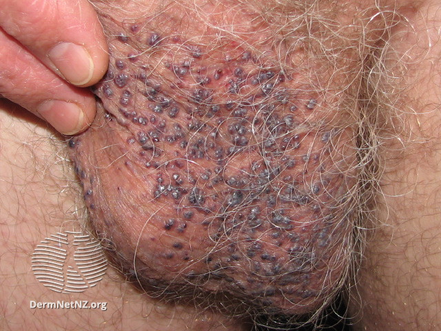 File:Angiokeratoma of Fordyce on scrotum (DermNet NZ angiokeratoma-36).jpg