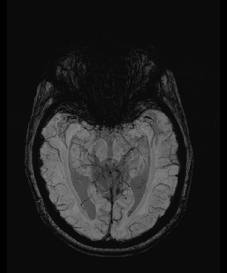 Angiomatous meningioma (Radiopaedia 79459-92579 E 26).jpg