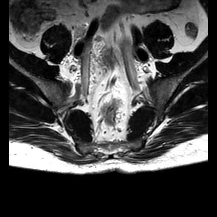 File:Ankylosing spondylitis with zygapophyseal arthritis (Radiopaedia 38433-40517 C 1).jpg
