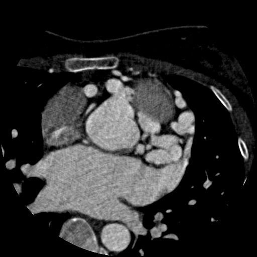 File:Anomalous left coronary artery from the pulmonary artery (ALCAPA) (Radiopaedia 40884-43586 A 22).jpg