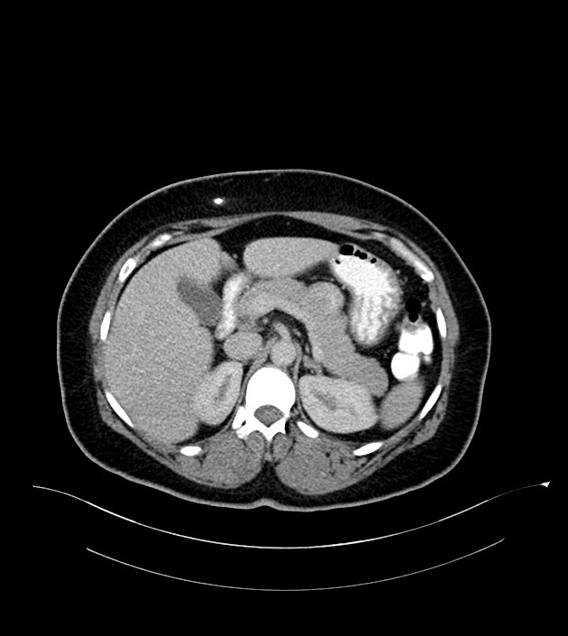 Anterior abdominal wall CSF pseudocyst (CSFoma) (Radiopaedia 79453-92571 A 31).jpg