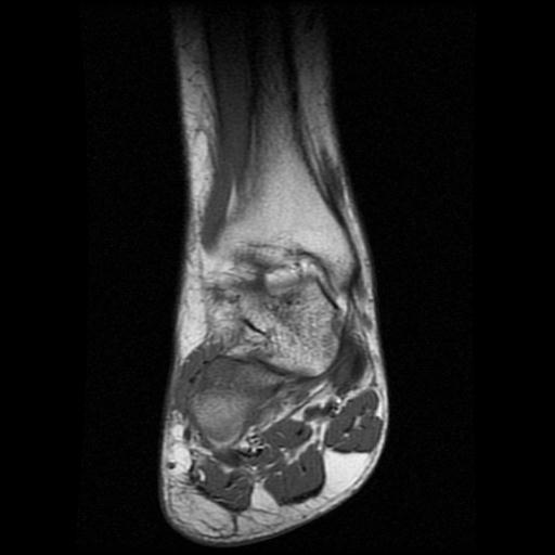 File:Anterior calcaneal process fracture (Radiopaedia 71377-81705 Coronal T1 5).jpg