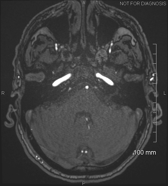 Anterior cerebral artery aneurysm (Radiopaedia 80683-94127 Axial MRA 51).jpg