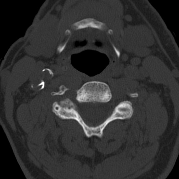 Anterior cervical postdiscectomy arthrodesis (Radiopaedia 32678-33646 Axial bone window 37).jpg