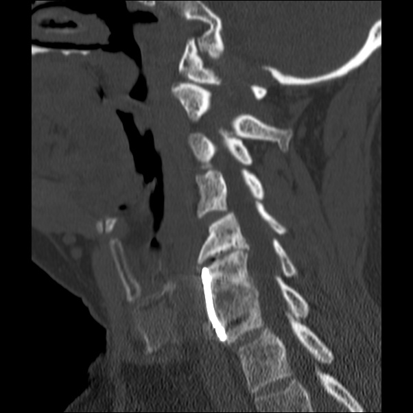 Anterior cervical postdiscectomy arthrodesis (Radiopaedia 32678-33646 Sagittal bone window 47).jpg