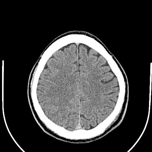 Anterior choroidal artery infarct (Radiopaedia 55106-61480 Axial non-contrast 44).jpg