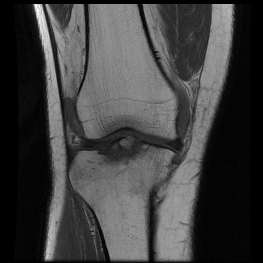 File:Anterior cruciate ligament avulsion fracture (Radiopaedia 58939-66193 Coronal T1 8).jpg